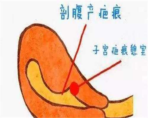 代妈招聘喜弟_孕宝代生儿子机构,人工授精哪几种方法比较好_人工授精具体如何