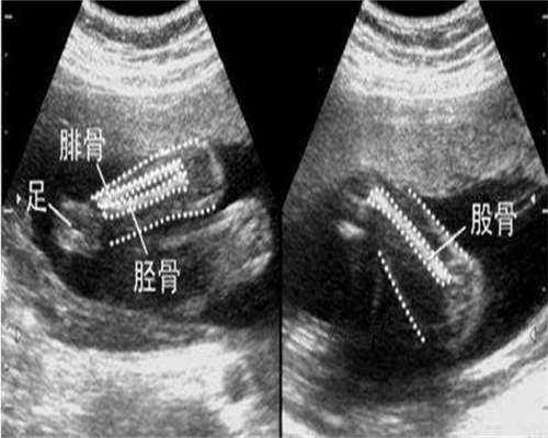 怀孕十周胎停怎么恢复
